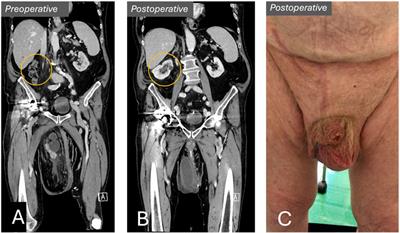 Case Report: A Rare Case of an Obstructed Floating Kidney Incarcerated Within a Massive Scrotal Hernia: Management at a Norwegian Hospital by Surgeons With Experience in Africa